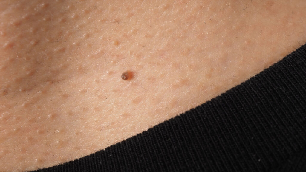 kaip išnaikinti papilomas ant kūno – stambiu planu matoma odos papiloma