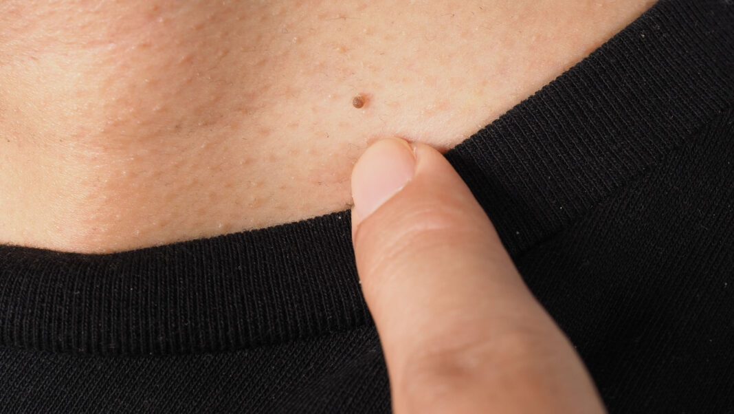 kaip išnaikinti papilomas ant kūno – pirštu rodoma odos ataugėlė