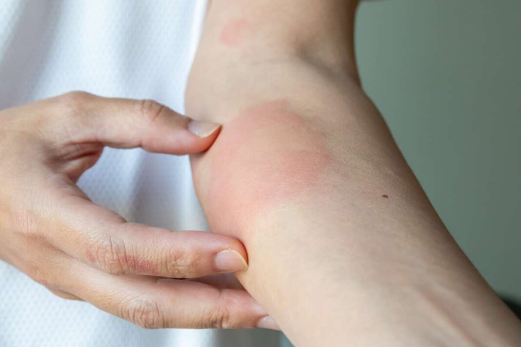 Svogūnas po įkandimo – patinusi ir paraudusi oda ant rankos