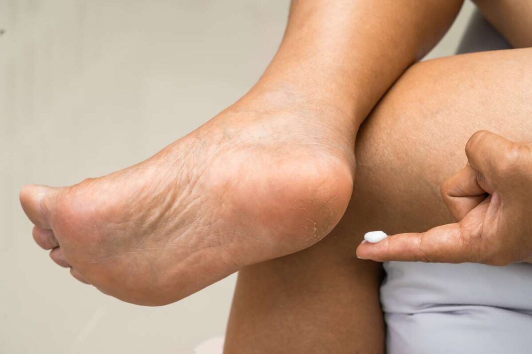 Tepama banano kaukė kulnams – natūrali pagalba suskilinėjusiai pėdų odai