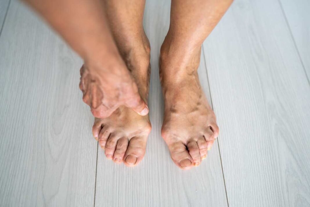 Kaip sumažinti kojų tinimą – spaudžiama patinusi pėda, ieškant palengvėjimo nuo skysčių kaupimosi.