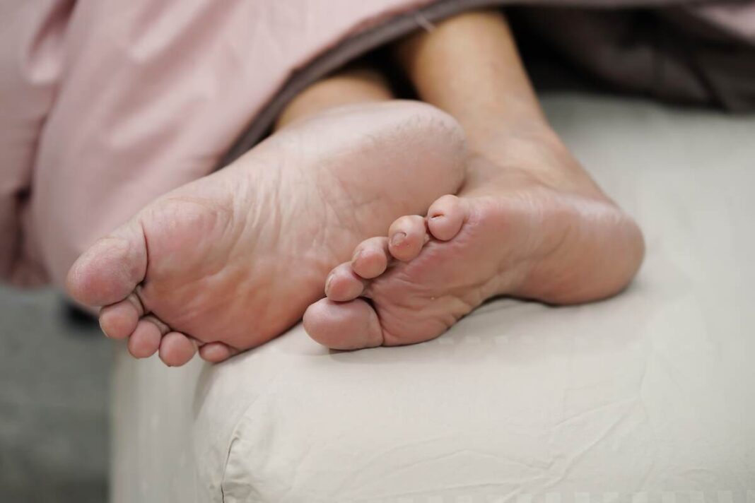 Pėdos su nagų grybelio požymiais – natūralus gydymas gali padėti atkurti nagų sveikatą ir išvaizdą.