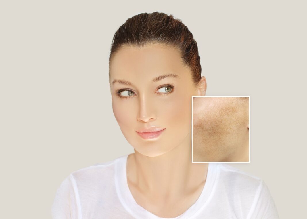 Natūralus pigmentinių dėmių šalinimas – jaunos moters veidas su padidintu vaizdu pigmentinės dėmės srityje.