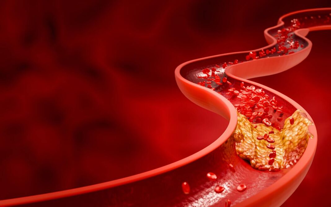 aukštas cholesterolis priežastys – kraujagyslėje matomos riebalų sankaupos, trukdančios normaliam kraujo tekėjimui.