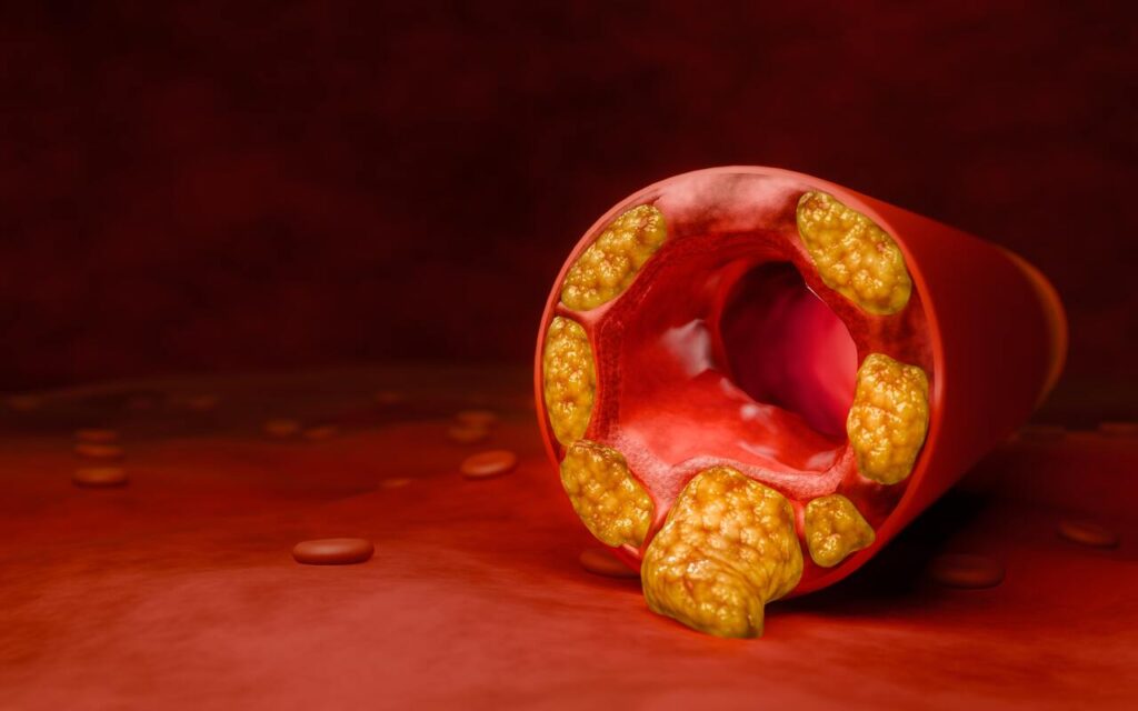 aukštas cholesterolis priežastys – kraujagyslė užsikimšusi geltonomis apnašomis, ribojančiomis kraujo tekėjimą.