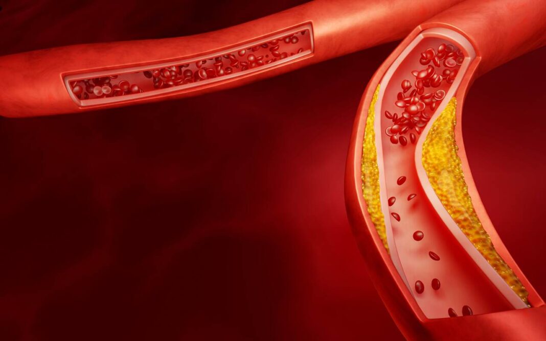 Užsikimšusi arterija dėl blogojo cholesterolio sankaupų.