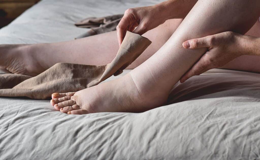 Natūralūs būdai nuo tinimo – patinusios kojos ir blauzdos, rodantis tinimo problemą.