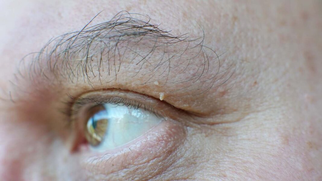 Papiloma ant akies voko šalia blakstienų linijos.