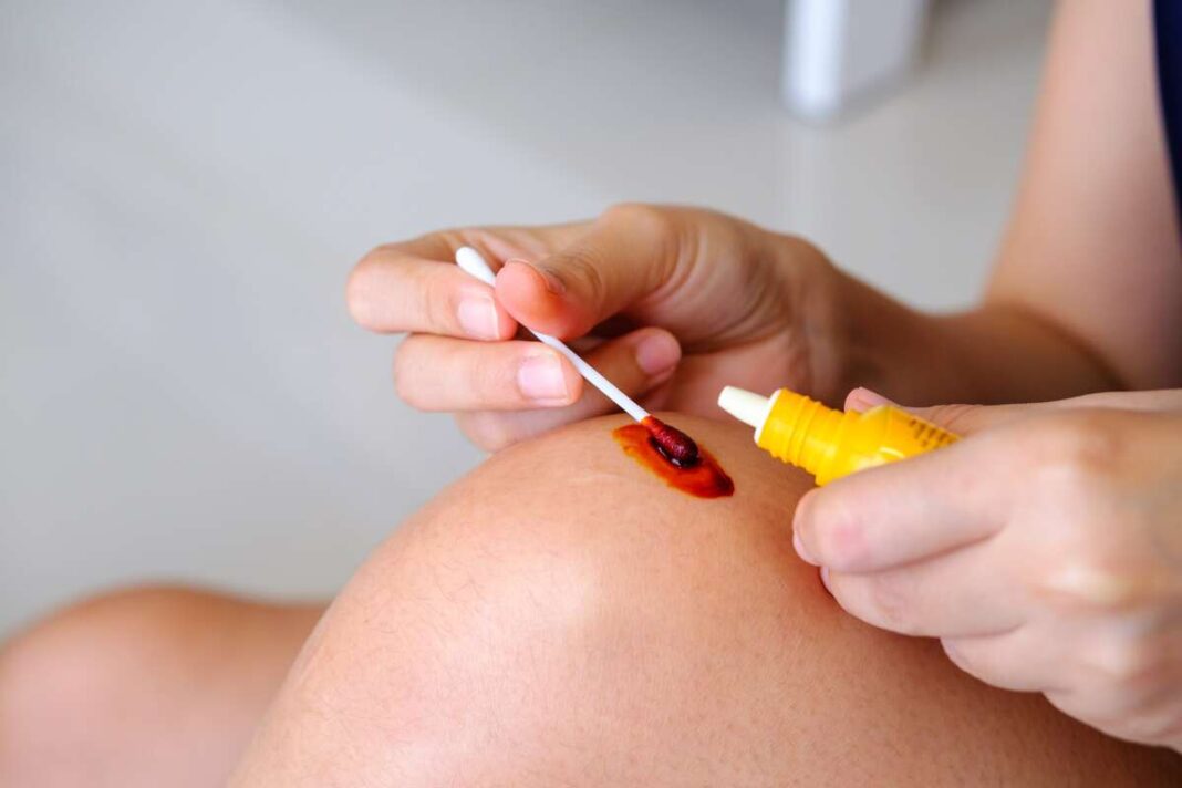 Vienas lašas jodo – dezinfekuojama nedidelė žaizda ant kelio, naudojant vatos pagaliuką.