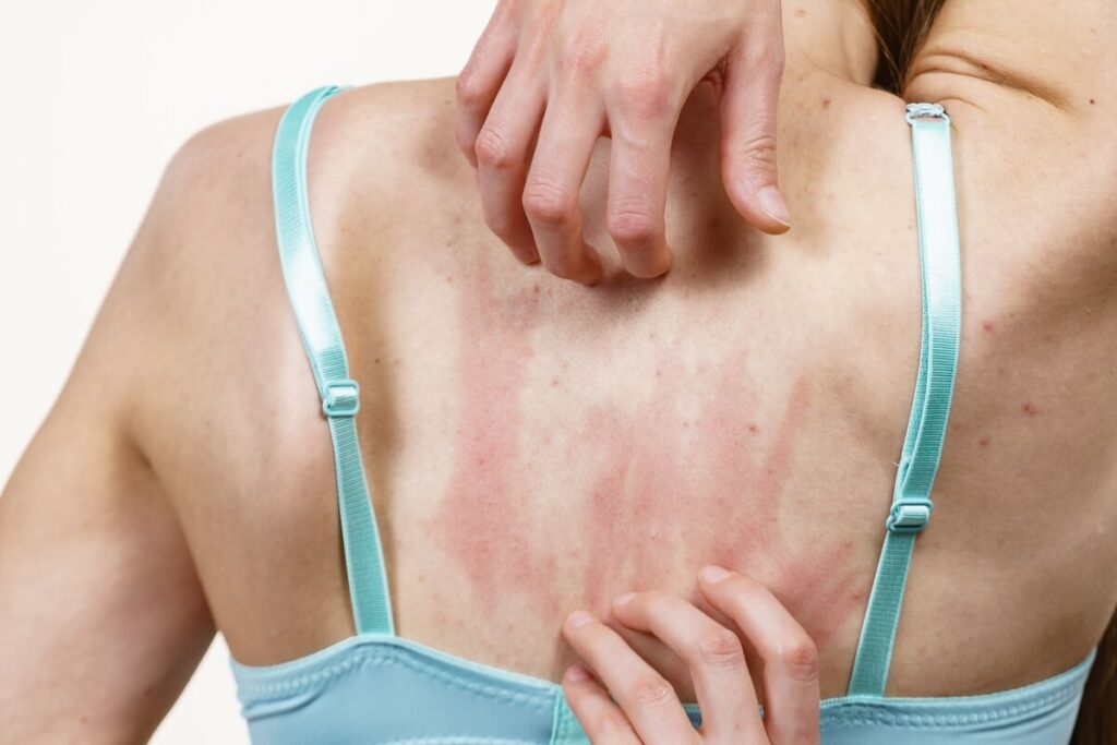 juostine pusleline pasireiškianti paraudimu ir odos sudirgimu ant nugaros