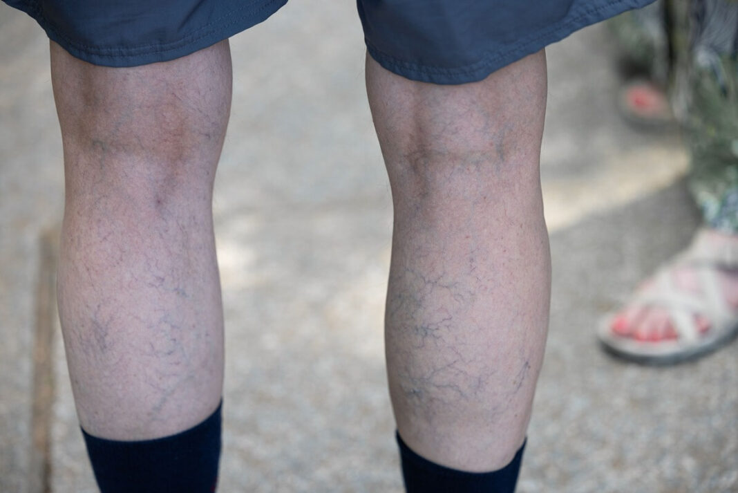 koju kraujotakai gerinti aktualios išryškėjusios venos ir pavargusios blauzdos iš arti