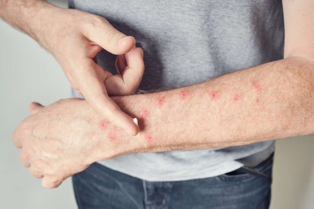 Raudoni taškai ant odos rankose tepant kremą sudirgintai sričiai nuraminti.