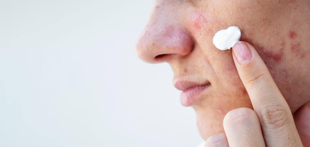 aknės priežastys jautrios odos tepimas kremu nuo spuogų